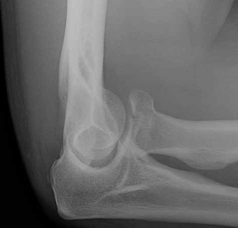 Radial Head Fracture Type 2